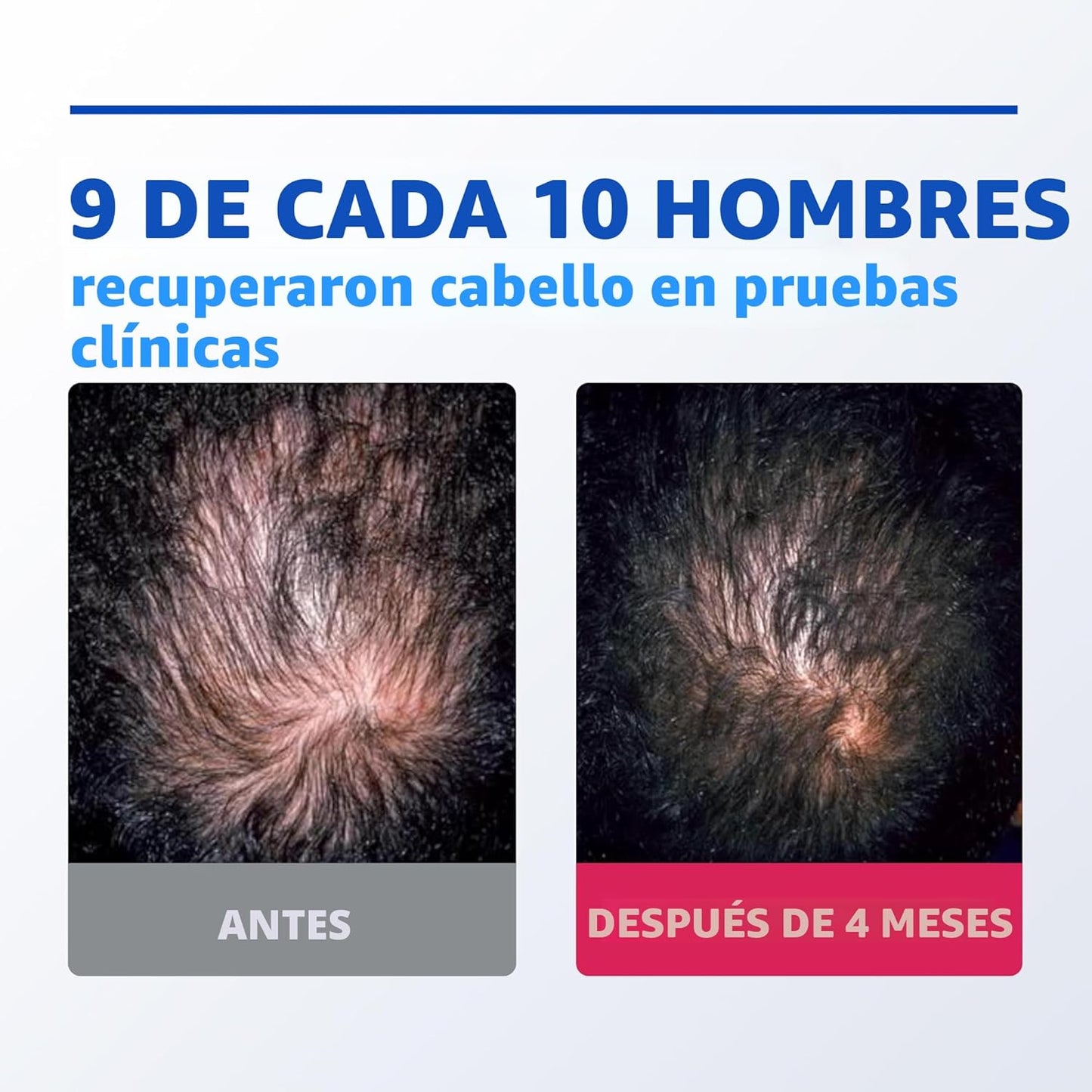 ROGAINE MEN ESPUMA - 60G - EVITA CAIDA DE CABELLO