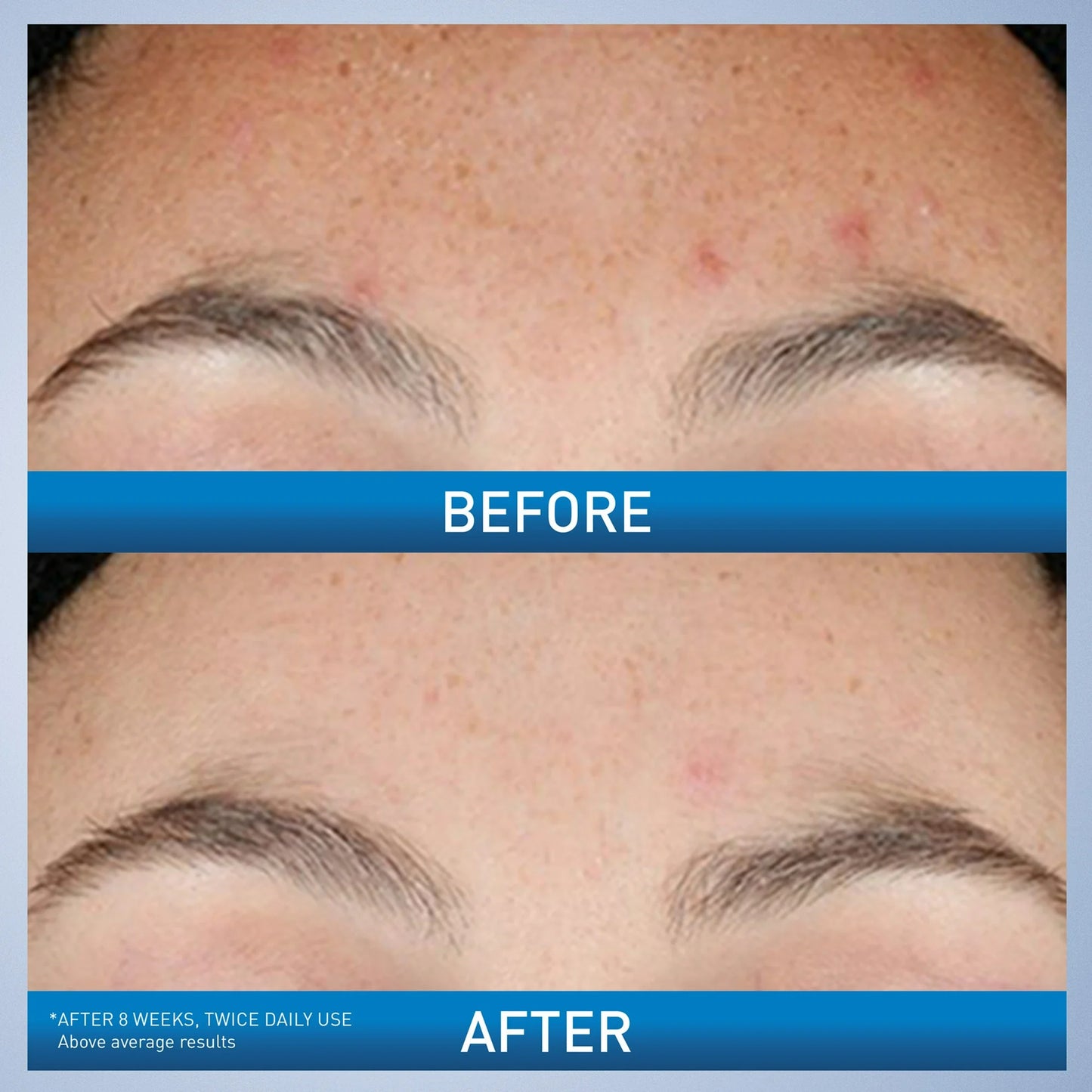 CeraVe Acne Resurfacing Retinol Face Serum para pieles con tendencia al acné, 30ml