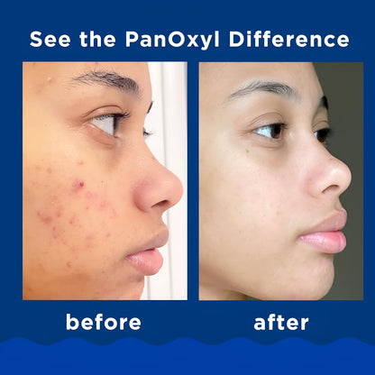 PanOxyl - Espuma limpiadora para el acné